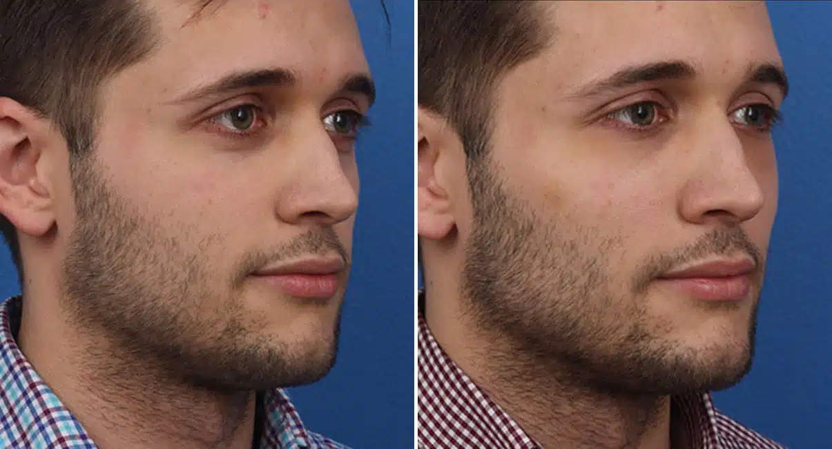 نتيجة تجميل للرجال — قبل وبعد